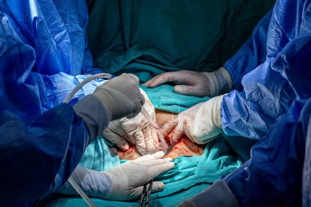 Chirurgen, die im Operationssaal einen Kaiserschnitt durchführen. Geburt mit Kaiserschnitt. Neues Leben, Geburt des Babys per Kaiserschnitt im Operationssaal (reifer Inhalt).