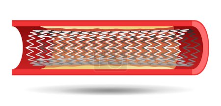 Illustration for Coronary stent in blood vessel - metal or plastic tube inserted into the lumen of vein to keep the passageway open - Royalty Free Image