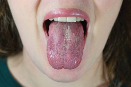 Foto de Oral Candidiasis or Oral trush (Candida albicans), yeast infection on the human tongue, common side effect when using antibiotics or another medicaments. Young woman with low immunity. - Imagen libre de derechos