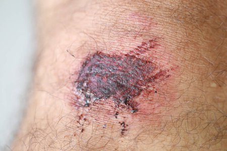 Téléchargez les photos : C'est une dermatite petites bosses verrues apparaissent sur la peau chez l'enfant. - en image libre de droit