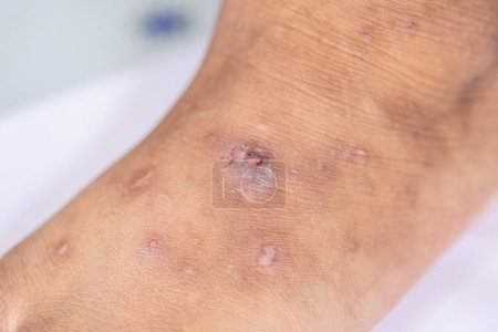 Muster atopischer Dermatitis und Pilzerkrankungen am menschlichen Körper.