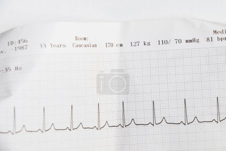 Photo for Cardiogram, waves of heart beat, EKG on the paper, arrhythmia - Royalty Free Image