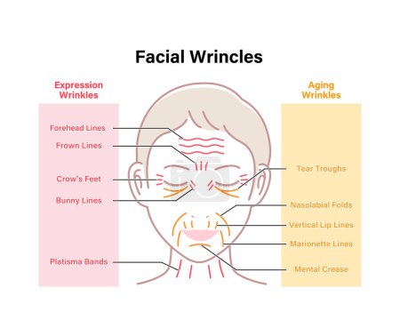 Illustration for Expression wrinkles and Aging wrinkles ( female face ) vector illustration - Royalty Free Image