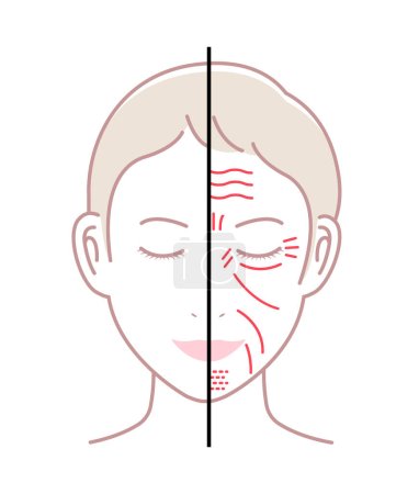Ilustración de Arrugas faciales (cara femenina) vector ilustración / sin texto - Imagen libre de derechos