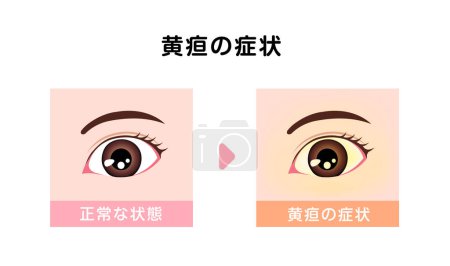 Illustration for Comparison illustration of normal and jaundiced eyes - Royalty Free Image