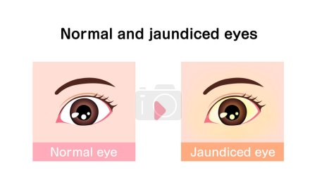Illustration for Comparison illustration of normal and jaundiced eyes - Royalty Free Image