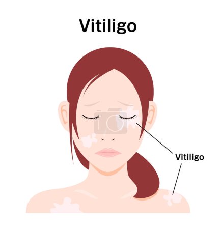 Illustration for Symptoms of Vitiligo vector illustration - Royalty Free Image