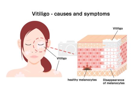 Téléchargez les illustrations : Causes et symptômes du vecteur Vitiligo illustration - en licence libre de droit