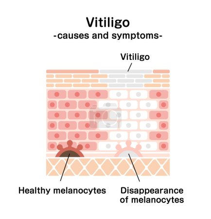 Causas y síntomas de la ilustración del vector Vitiligo