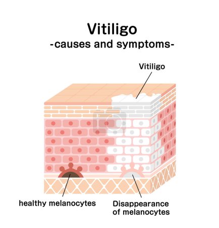 Ursachen und Symptome von Vitiligo Vektor Illustration