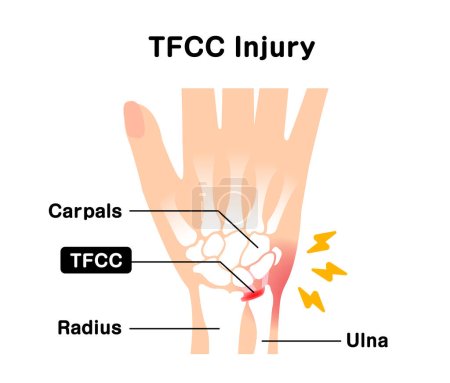 About TFCC injury. Vector illustration