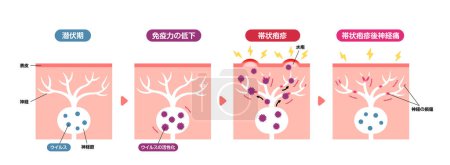 Mechanismus der Gürtelrose (Herpes zoster) Vektorillustration (einschließlich postherpetischer Neuralgie))