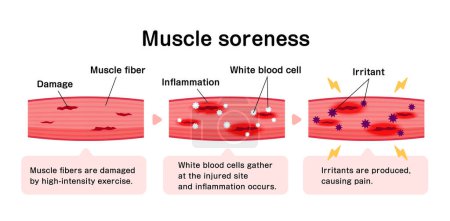 Mechanism of muscle soreness vector illustration