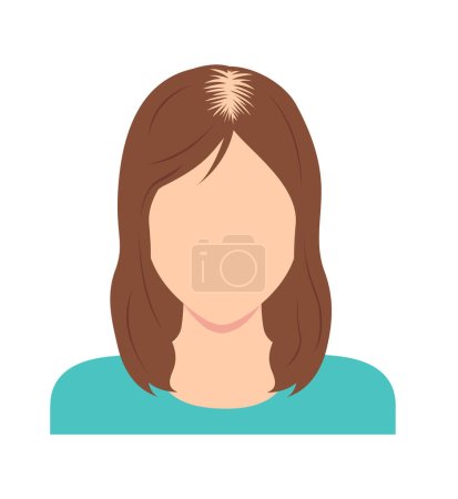 Illustration vectorielle de l'alopécie androgénétique féminine