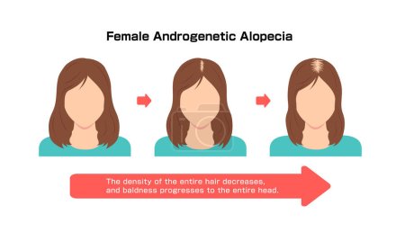 Fortschritt der weiblichen Androgenetischen Alopezie. Vektorillustration