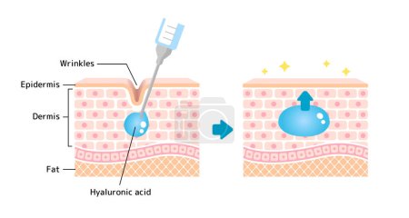 Illustration for Mechanism illustration of hyaluronic acid injection (cross-sectional view of the skin) - Royalty Free Image