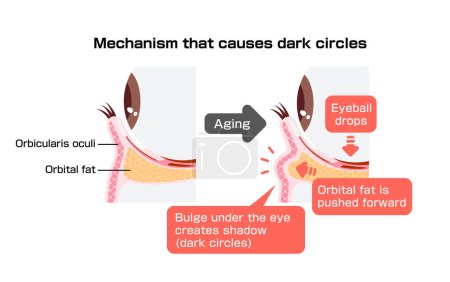 Mechanismus der Augenringe durch Alterung verursacht. Vektorillustration des Querschnitts.