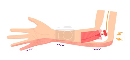 Illustration for Cubital tunnel syndrome vector illustration - Royalty Free Image