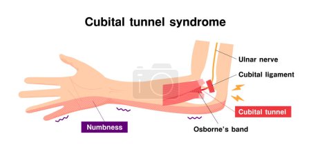 Téléchargez les illustrations : Illustration vectorielle du syndrome du tunnel cubital - en licence libre de droit