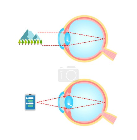 Téléchargez les illustrations : Mécanisme de globe oculaire pour regarder loin et près. Illustration vectorielle. - en licence libre de droit