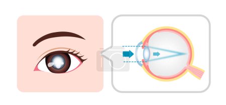 Illustration for Causes and mechanism of cataract vector illustration - Royalty Free Image