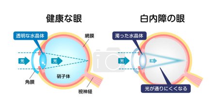 Téléchargez les illustrations : Causes et mécanisme de l'illustration vectorielle de la cataracte - en licence libre de droit