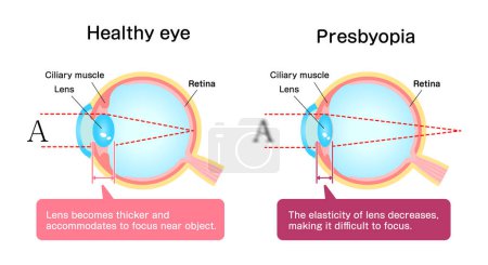 Illustration for Causes and mechanism of cataract vector illustration - Royalty Free Image