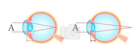Téléchargez les illustrations : Causes et mécanisme de l'illustration vectorielle de la cataracte - en licence libre de droit