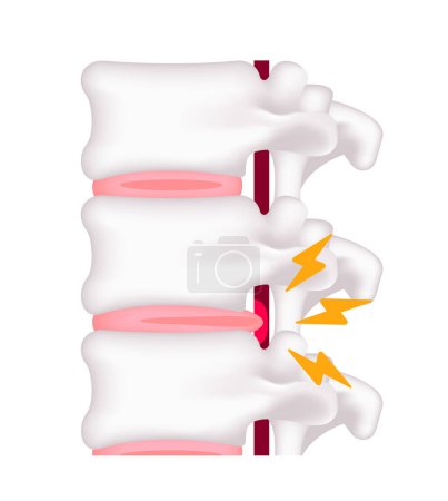 Spinal disc herniation vector illustration