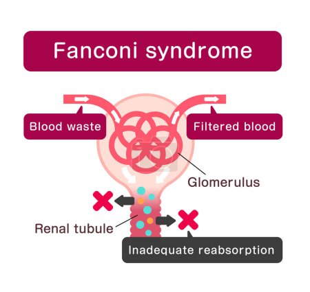 Fanconi-Syndrom verursacht Vektorillustration