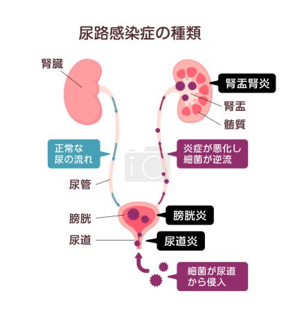 Illustration vectorielle d'infection urinaire