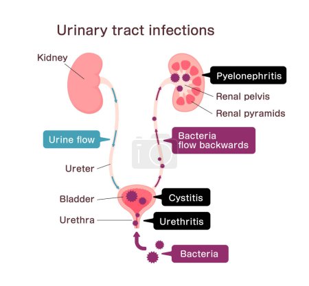 Illustration for Urinary tract infection vector illustration - Royalty Free Image