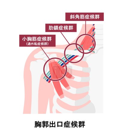 Ilustración vectorial de dónde se produce el síndrome de salida torácica
