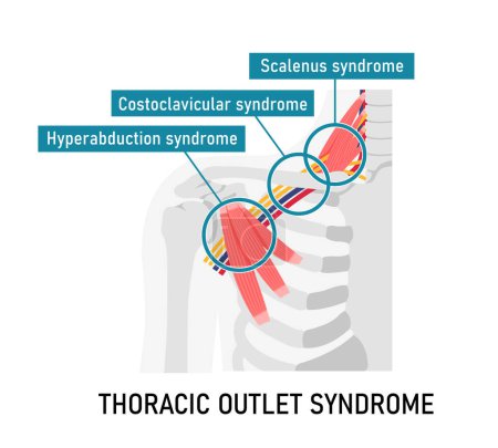 Illustration for Vector illustration of where thoracic outlet syndrome occurs - Royalty Free Image