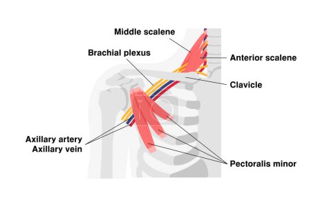 Ilustración vectorial de dónde se produce el síndrome de salida torácica