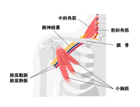Illustration for Vector illustration of where thoracic outlet syndrome occurs - Royalty Free Image