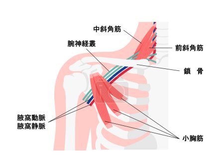 Illustration vectorielle de l'endroit où survient le syndrome de sortie thoracique