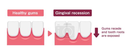 Illustration for Vector illustration of healthy gums and gingival recession - Royalty Free Image