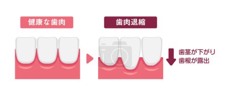 Illustration for Vector illustration of healthy gums and gingival recession - Royalty Free Image