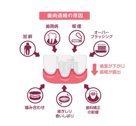 Causes of gingival recession. Vector illustration.