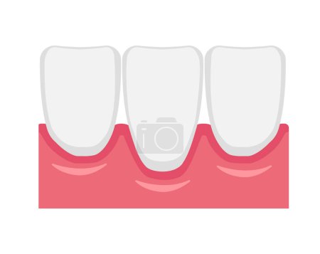 Vector illustration of gingival recession