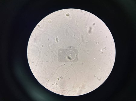 Photo for Budding yeast with pseudo hephae in urine laboratory. - Royalty Free Image