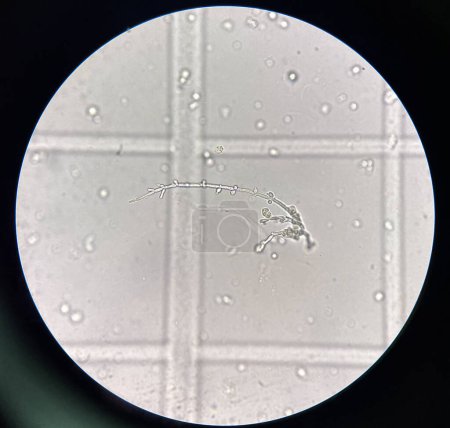 Photo for Budding yeast with pseudo hephae in urine laboratory. - Royalty Free Image