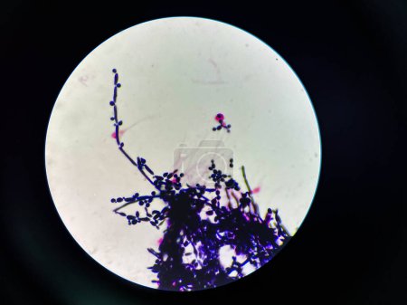 Photo for Budding yeast with pseudo hephae in urine Gram stain. - Royalty Free Image