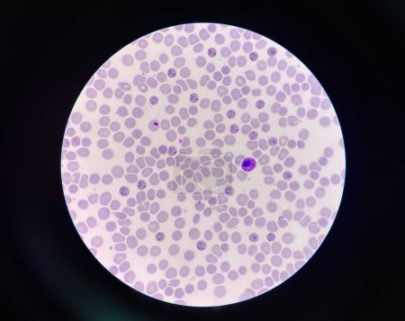 Téléchargez les photos : Malaria pigment in RBC  blood parasite infected red blood cells. - en image libre de droit