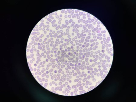 Téléchargez les photos : Malaria pigment in RBC  blood parasite infected red blood cells. - en image libre de droit