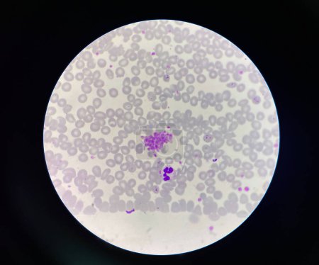 Téléchargez les photos : Malaria pigment blood parasite infected rbc.Thin film. - en image libre de droit