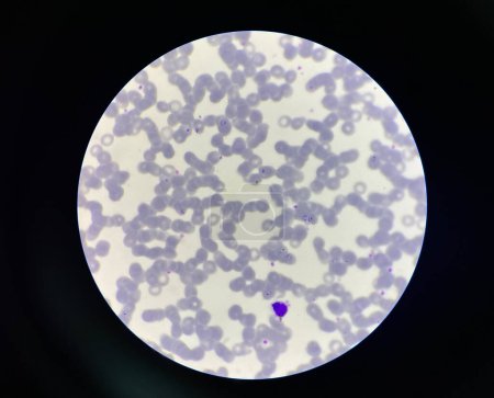 Téléchargez les photos : Malaria pigment blood parasite infected rbc.Thick film. - en image libre de droit
