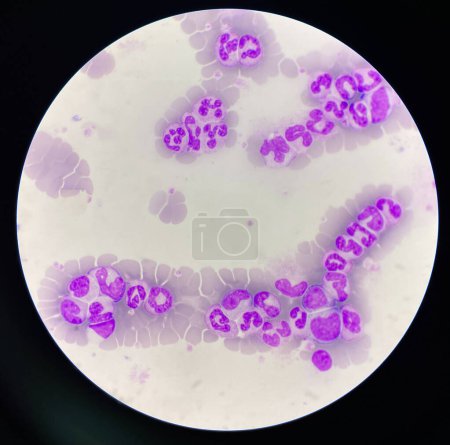 Photo for Shift to the left neutrophil in smear CBC lab. - Royalty Free Image