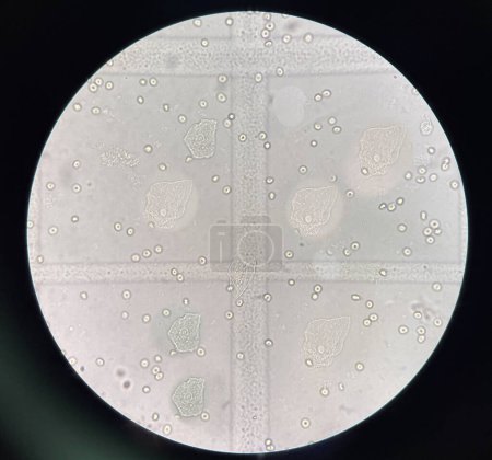 Photo for Renal epithelial cell with rbc in Urine examination. - Royalty Free Image